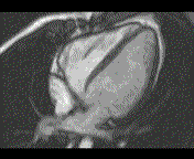 MRI Normal
                        pericardium, Dr. P. Alter (copyright)