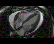 MRI Pericardial effusion,
                        Dr. P. Alter (copyright)
